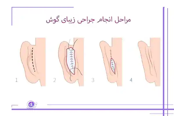 مراحل اتوپلاستی