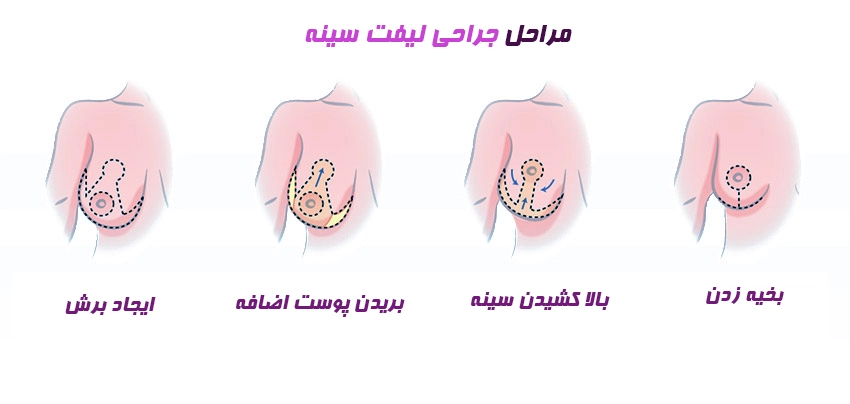 مراحل عمل جراحی لیفت سینه