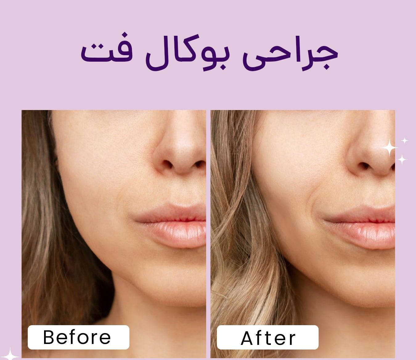 آیا چربی بوکال بعد از کاهش وزن کم می شود؟ تأثیر کاهش وزن بر بوکال