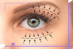 جراحی پلک برای چه کسانی مناسب است؟