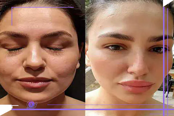 تأثیر ژنتیک بر چربی بوکال، چرا بعضی افراد صورت لاغرتر دارند؟ تأثیر ژنتیک بر چربی بوکال