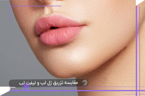 مقایسه سانترال لب و فیلر لب