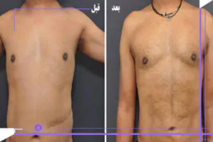 مراقبت ‌های قبل و بعد از لیپوساکشن