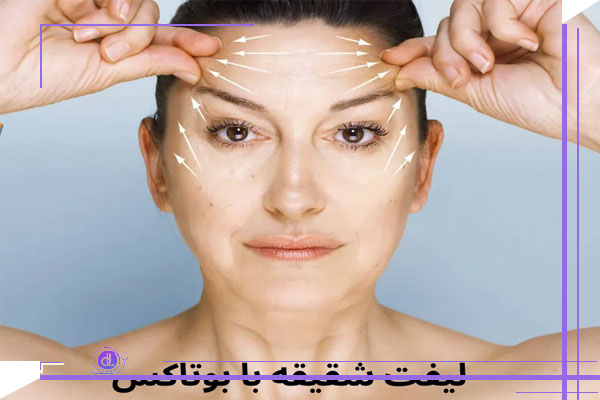بوتاکس شقیقه