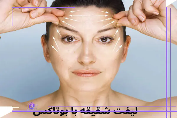 بوتاکس شقیقه
