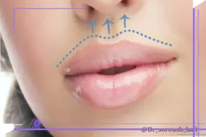 ممنوعیت های جراحی سانترال لب