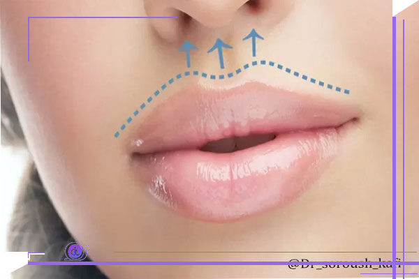 ممنوعیت های جراحی سانترال لب