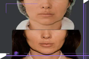مراقبت ‌های قبل و بعد بوکال فت
