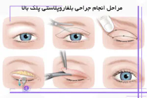 مراحل جراحی بلفاروپلاستی