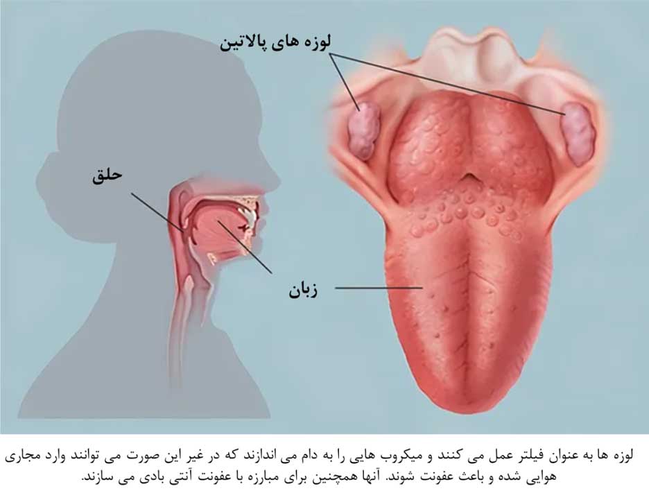 درمان مشکلات ناشی از لوزه