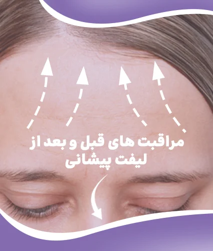 لیفت پیشانی