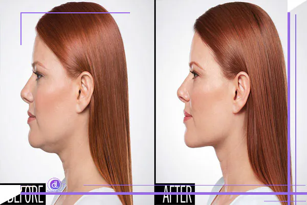 تزریق چربی و فیلر برای غبغب، مراحل، کاربردها و تفاوت های آنها تزریق چربی و فیلر برای غبغب