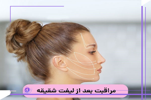 مراقبت های بعد از لیفت شقیقه