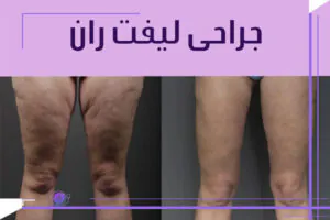 جایگزین جراحی سانترال