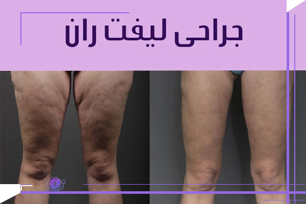 مراقبت های بعد لیفت ران، نکات مهم نقاهت و بهبودی سریع