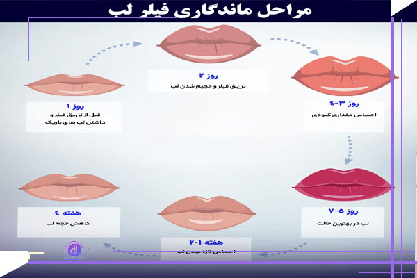 مدت زمان و عوامل مؤثر بر ماندگاری فیلرها