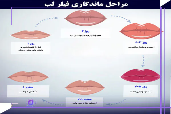 مدت زمان و عوامل مؤثر بر ماندگاری فیلرها