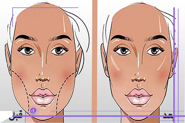 چگونه بهترین جراح برای عمل بوکال فت را انتخاب کنیم؟