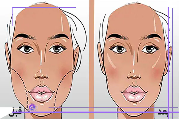 چگونه بهترین جراح برای عمل بوکال فت را انتخاب کنیم؟