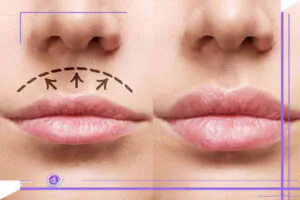 روش های جدید جراحی سانترال لب