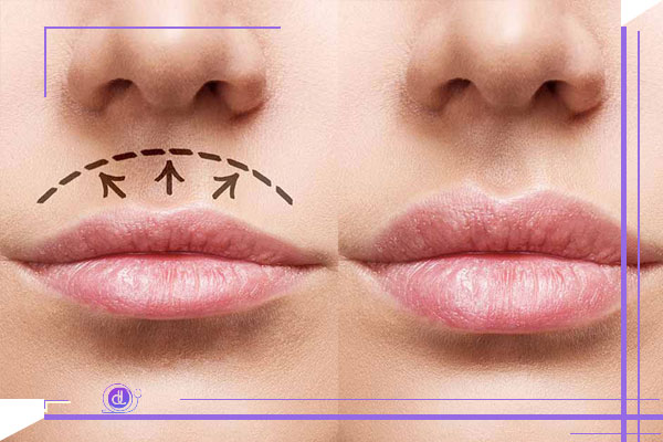 روش های جدید جراحی سانترال لب
