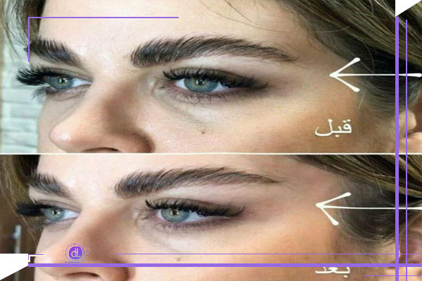 ماندگاری لیفت شقیقه: بررسی عوامل مؤثر بر دوام نتایج