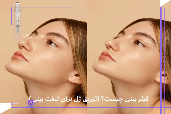 فیلر بینی