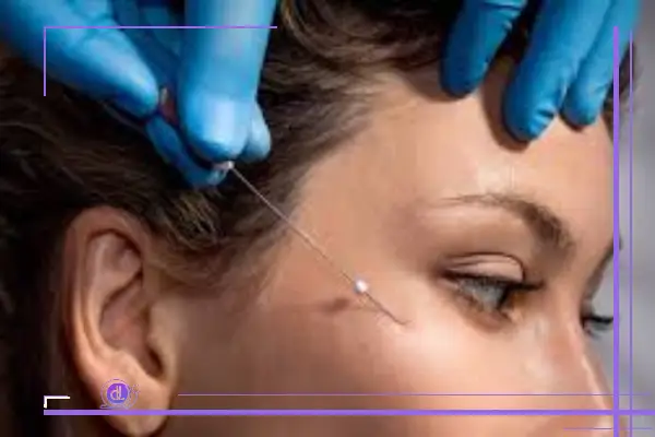 لیفت شقیقه با نخ