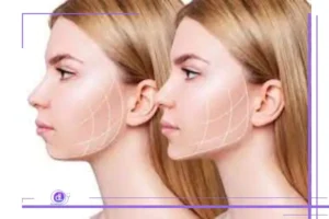 کاهش چربی بوکال بدون جراحی