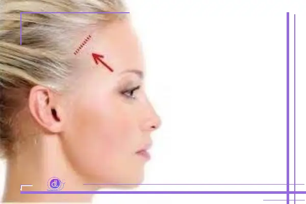 لیفت شقیقه در شیراز