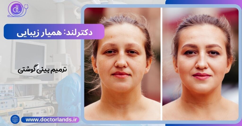 عکسهای ترمیم بینی ترمیم بینی گوشتی عمل سرپایی ترمیم بینی