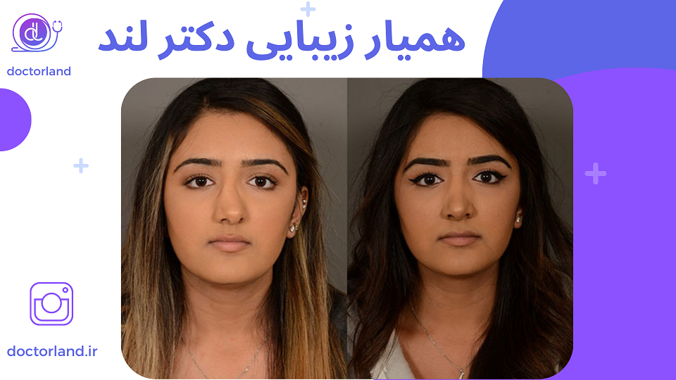 جراحی سپتوپلاستی جراحی سپتوپلاستی