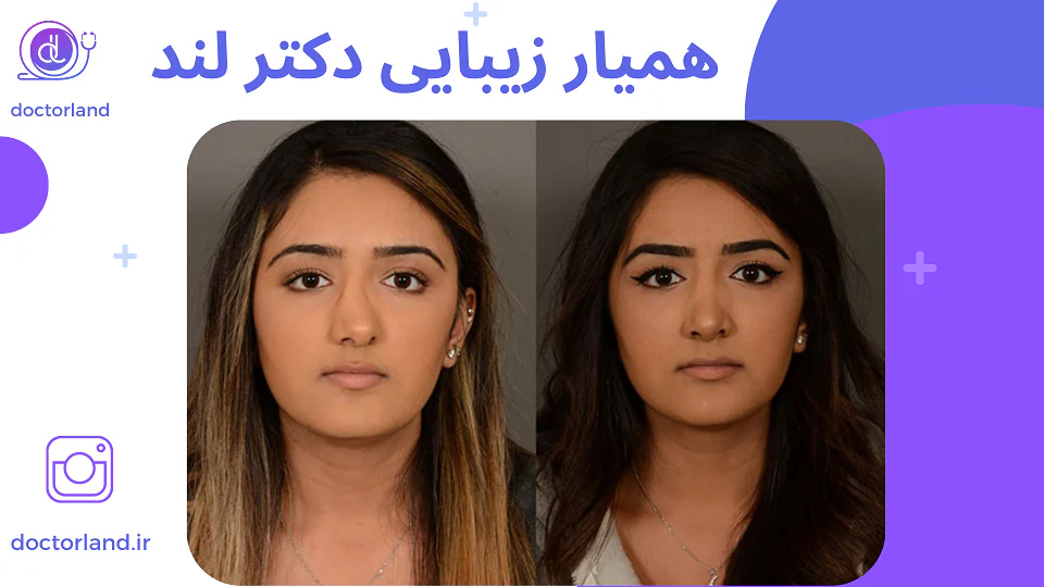 جراحی سپتوپلاستی چیست؟ | مزایای و معایب عمل سپتوپلاستی بینی جراحی سپتوپلاستی