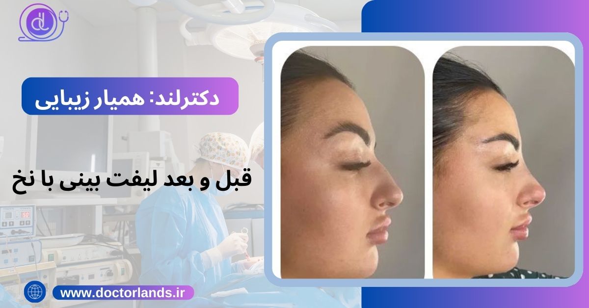 عکس قبل و بعد لیفت بینی با نخ