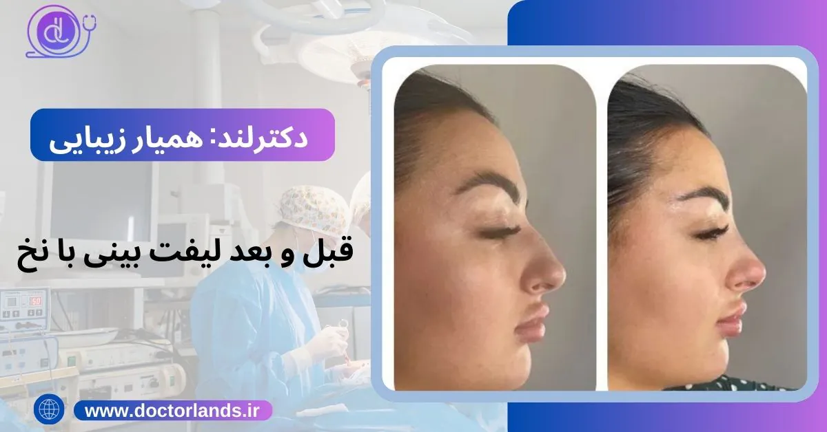 لیفت بینی | لیفت بینی با نخ + مزایا و معایب لیفت بینی + هزینه ها عکس قبل و بعد لیفت بینی با نخ