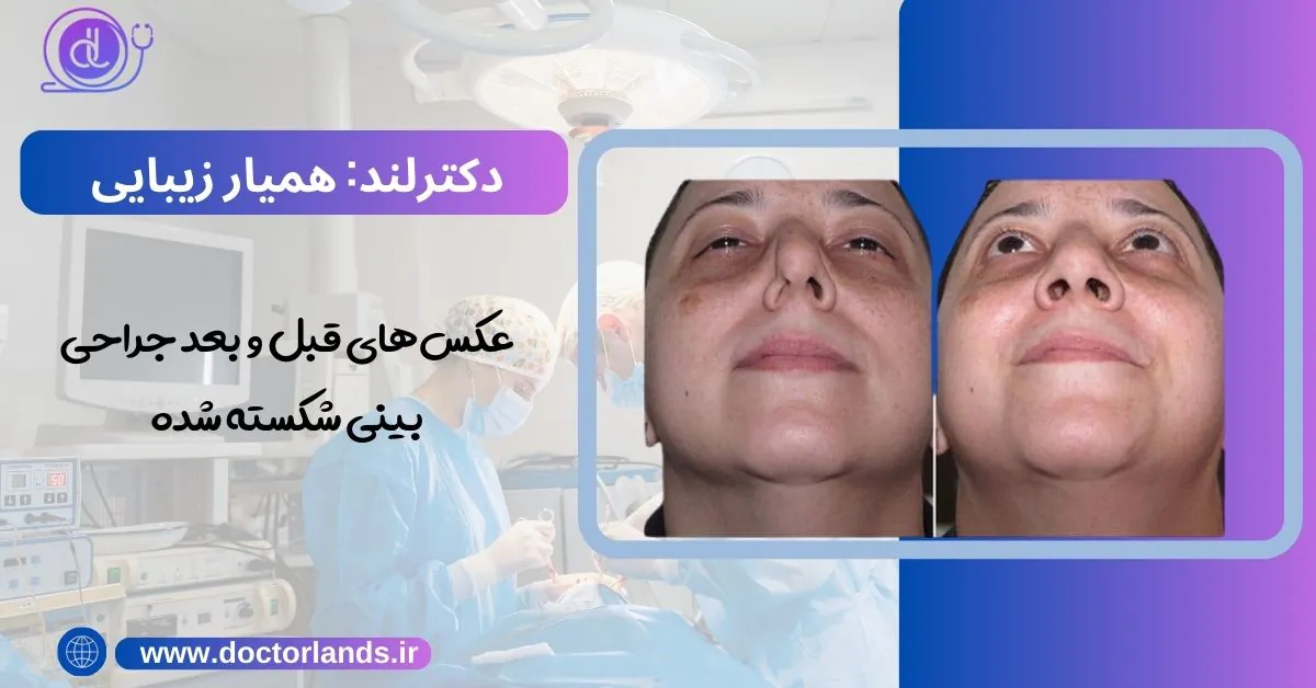 عمل بینی شکسته | 0 تا 100 جراحی بینی شکسته + نکات مهم عکسهای قبل و بعد جراحی بینی شکسته شده