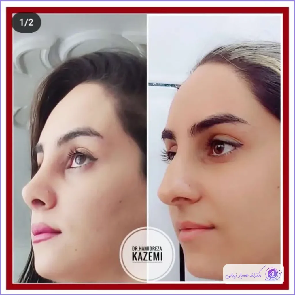 عمل بینی قوزدار | روشهای جراحی و لیست بهترین جراحان بینی قوزدار نمونه قبل و بعد جراحی بینی قوز دار