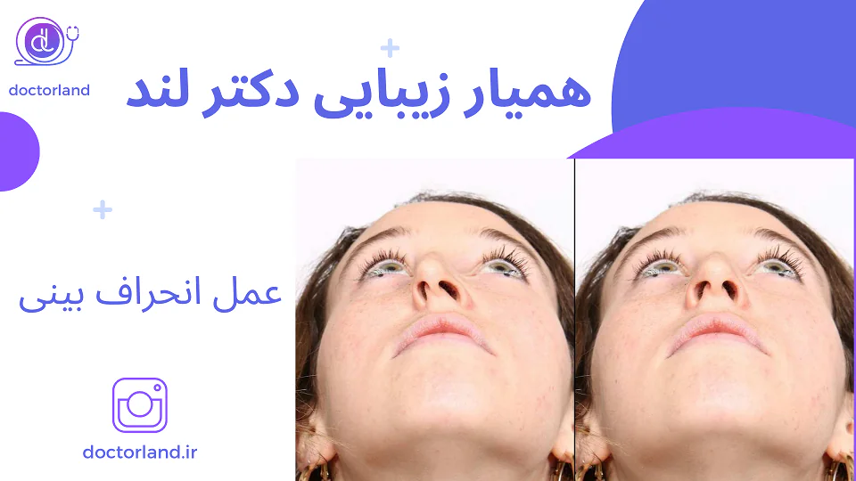 عمل انحراف بینی؛ دلایل، علائم و درمان قطعی انحراف بینی عکس قبل و بعد عمل انحراف بینی