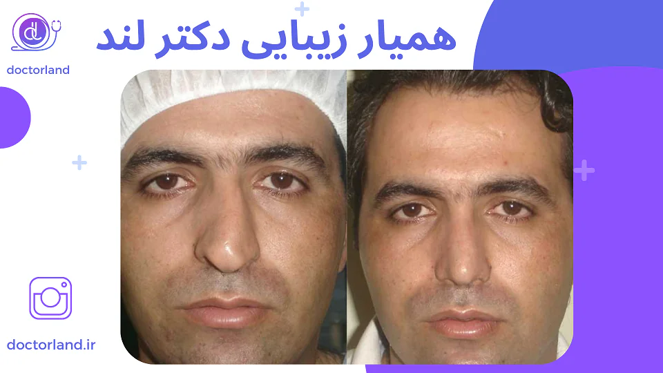 عمل انحراف بینی؛ دلایل، علائم و درمان قطعی انحراف بینی عمل انحراف بینی