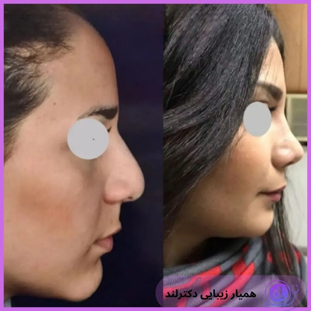 عمل بینی نیمه فانتزی؛ از 0 تا 100 جراحی بینی نیمه فانتزی عمل بینی نیمه فانتزی-3