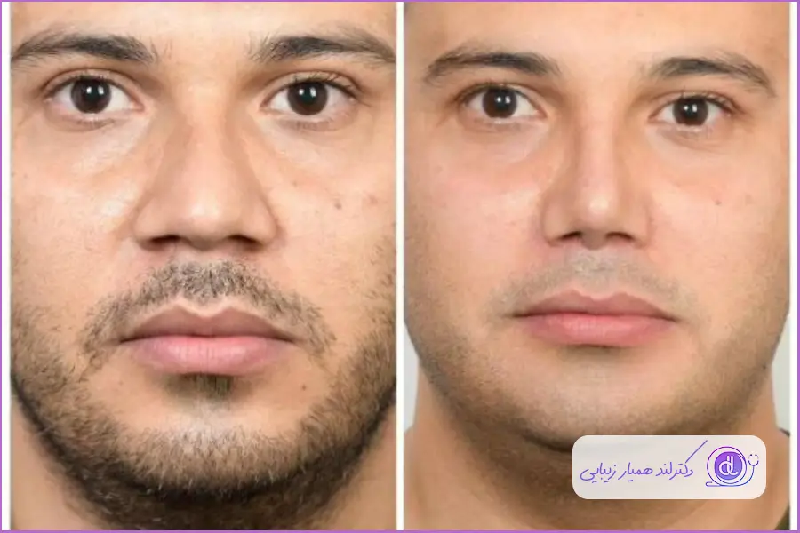 عمل بینی گوشتی