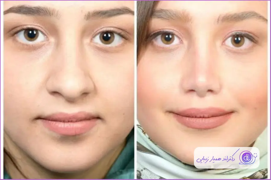 عمل بینی گوشتی