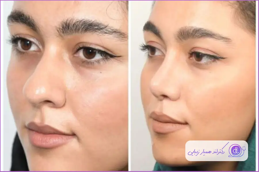 عمل بینی گوشتی