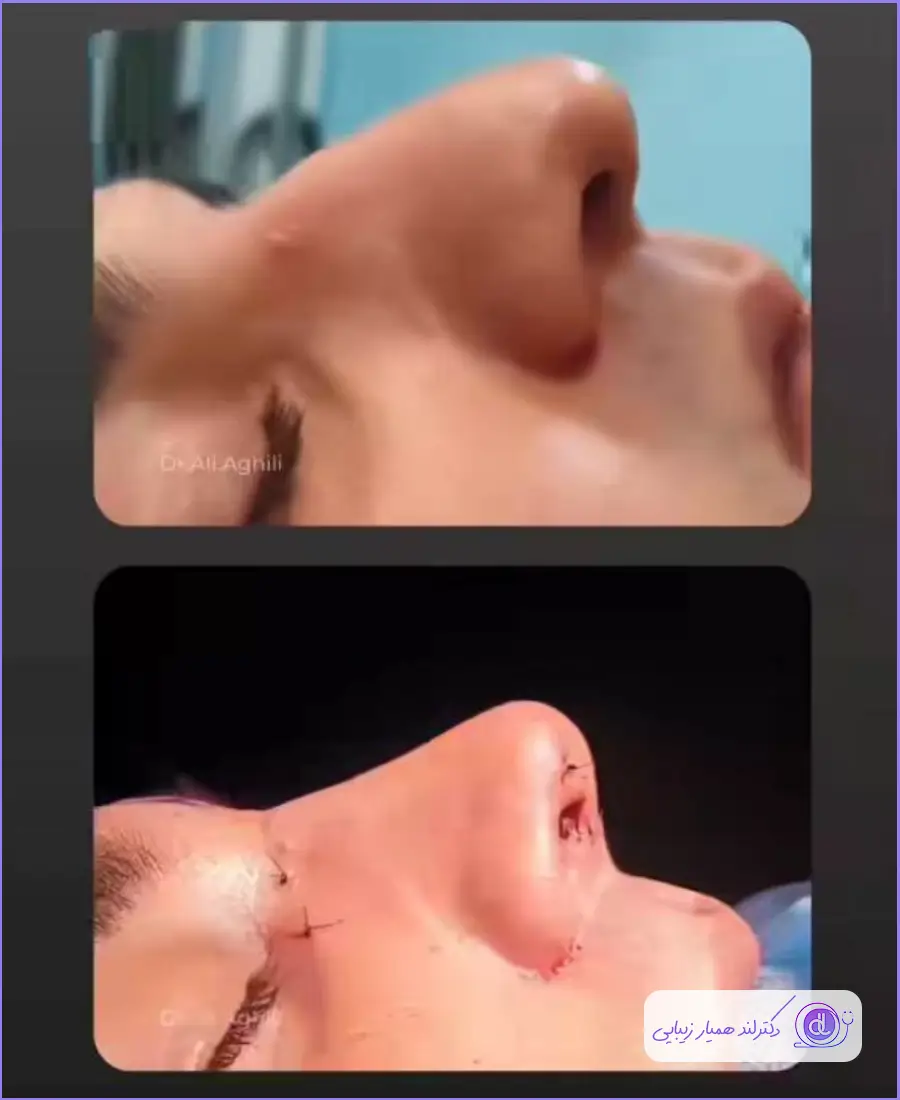 عمل بینی مردانه | بهترین مدلها و روشهای جراحی بینی برای آقایان عمل زیبایی دماغ گوشتی مردانه دکتر علی عقیلی