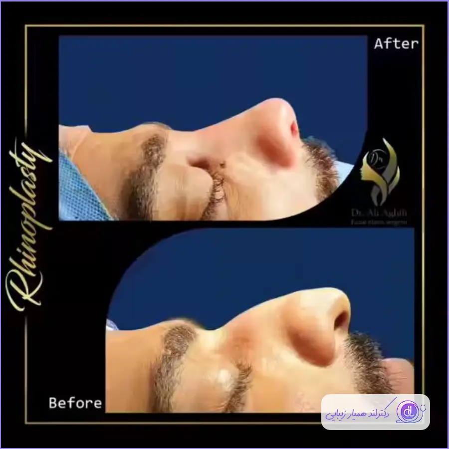 عمل نوک بینی چگونه است؟ | هزینه + جراحان نمونه نمونه قبل و بعد عمل نوک بینی گوشتی