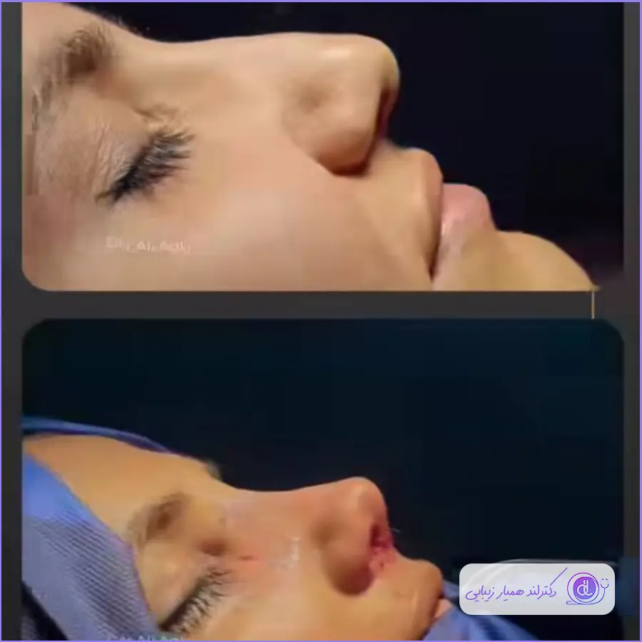 عمل بینی نیمه فانتزی؛ از 0 تا 100 جراحی بینی نیمه فانتزی عمل بینی نیمه فانتزی-6