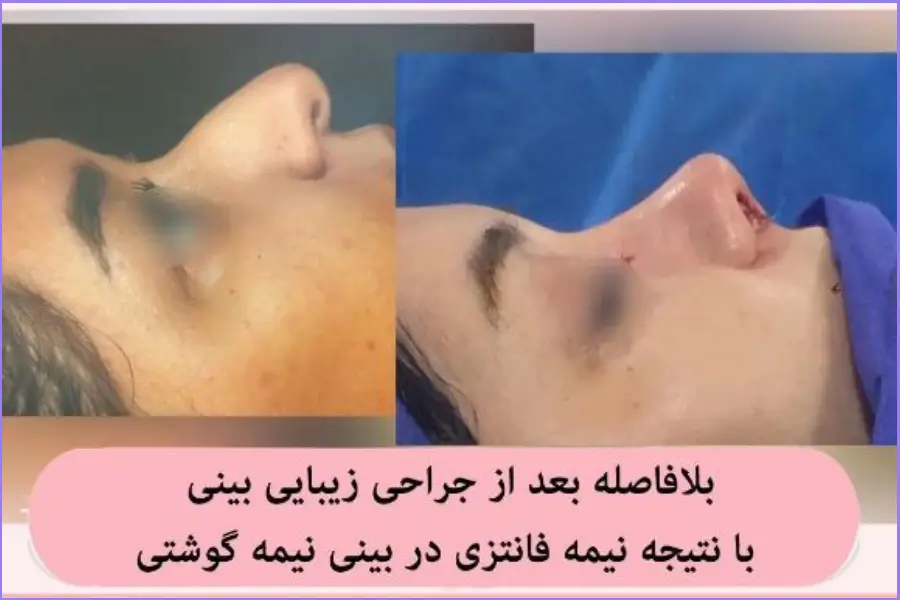 عمل بینی قوزدار | روشهای جراحی و لیست بهترین جراحان بینی قوزدار تبدیل بینی قوزدار به بینی نیمه فانتزی دکتر علی اصغر نریمانی