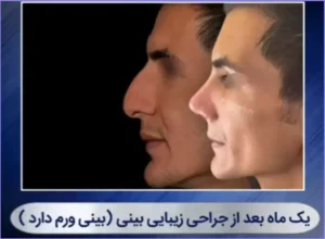 عمل بینی استخوانی؛ مدلهای پرطرفدار و نکات طلایی جراحی عمل بینی استخوانی-4