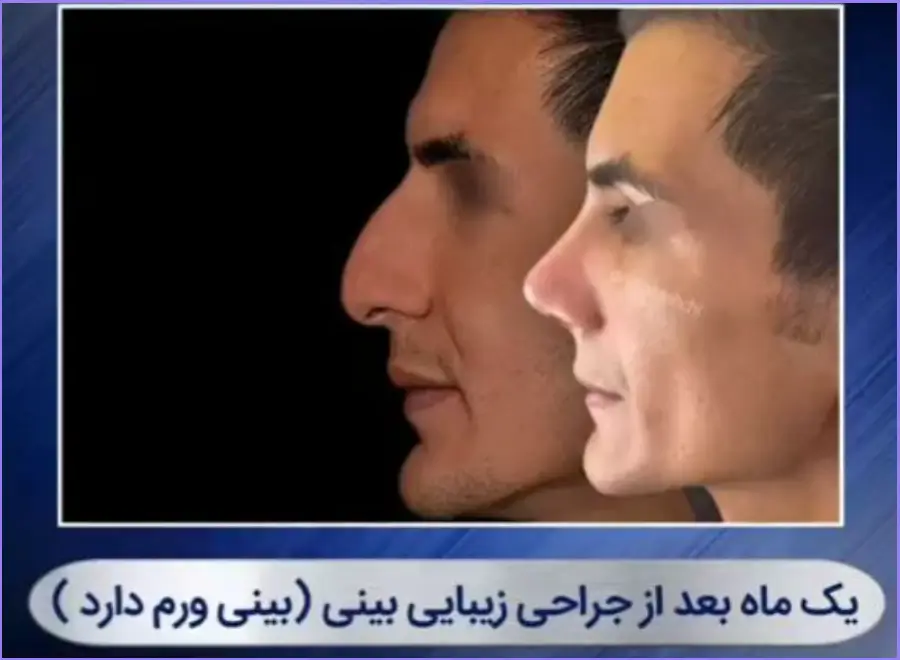 عمل بینی مردانه | بهترین مدلها و روشهای جراحی بینی برای آقایان عمل جراحی بینی گوشتی مردانه سبک فانتزی