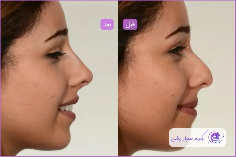 کوچک کردن بینی گوشتی | راهکارهای غیرجراحی و ایمن قبل و بعد بینی گوشتی بدون جراحی دماغ
